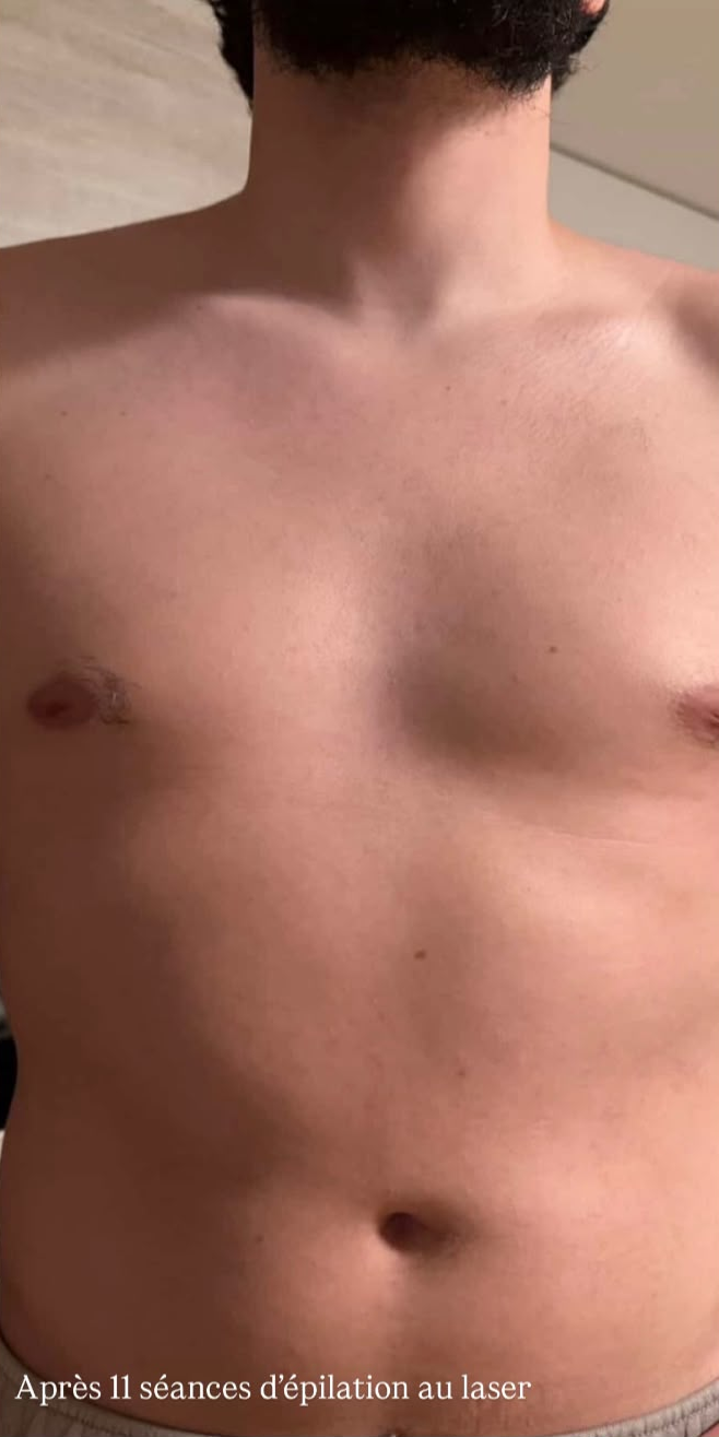Après — Épilation au laser